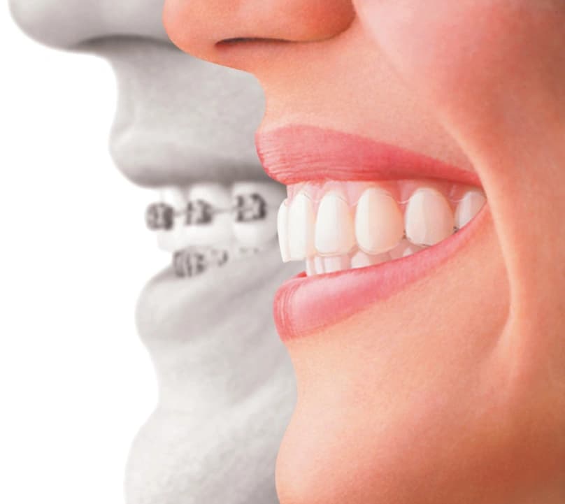 Sorria! Ninguém vai reparar que está a usar aparelho!