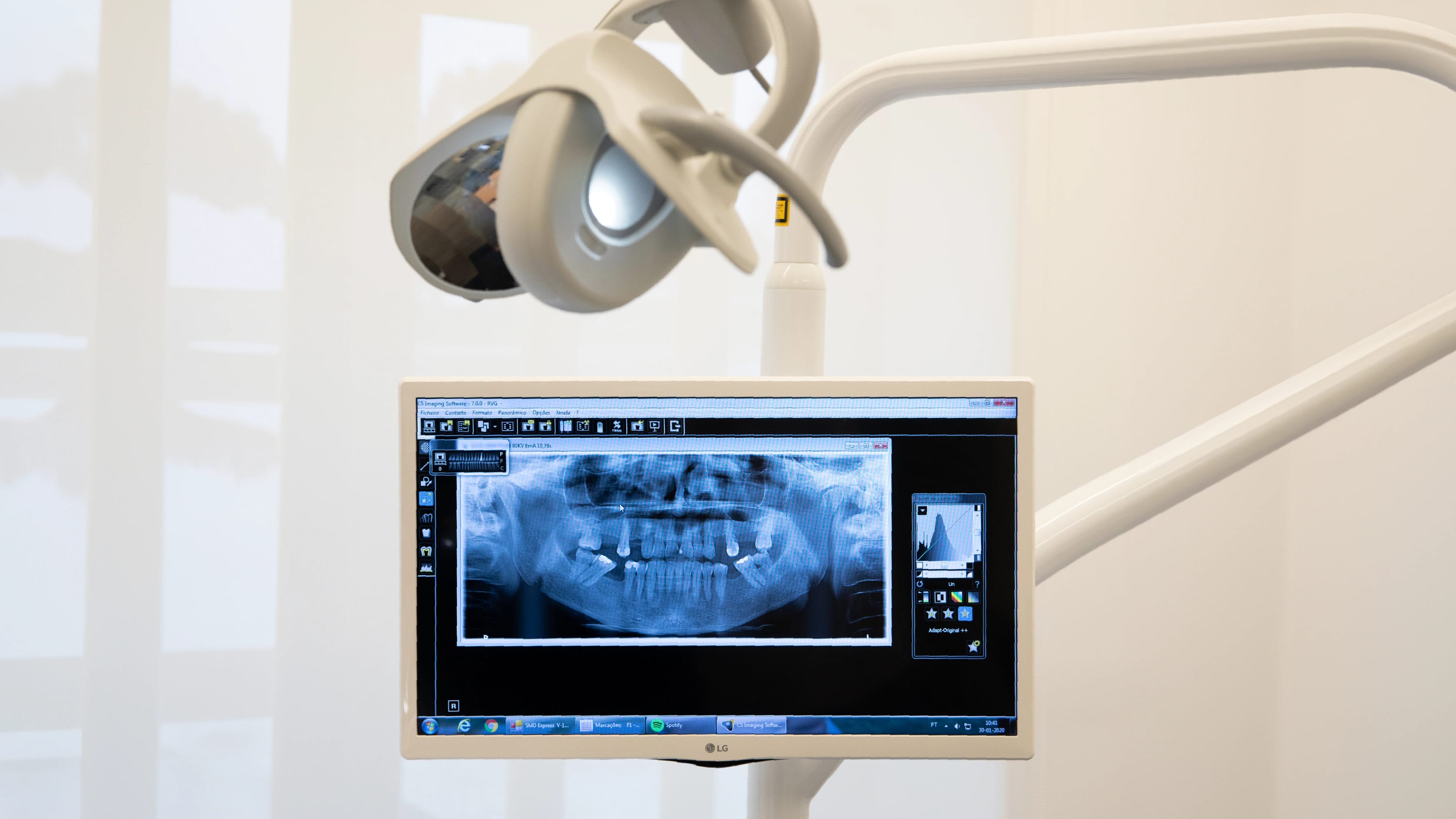 Implantologia: Recupere o seu sorriso através da técnica All-On-4 Implantologia: Recupere o seu sorriso através da técnica All-On-4