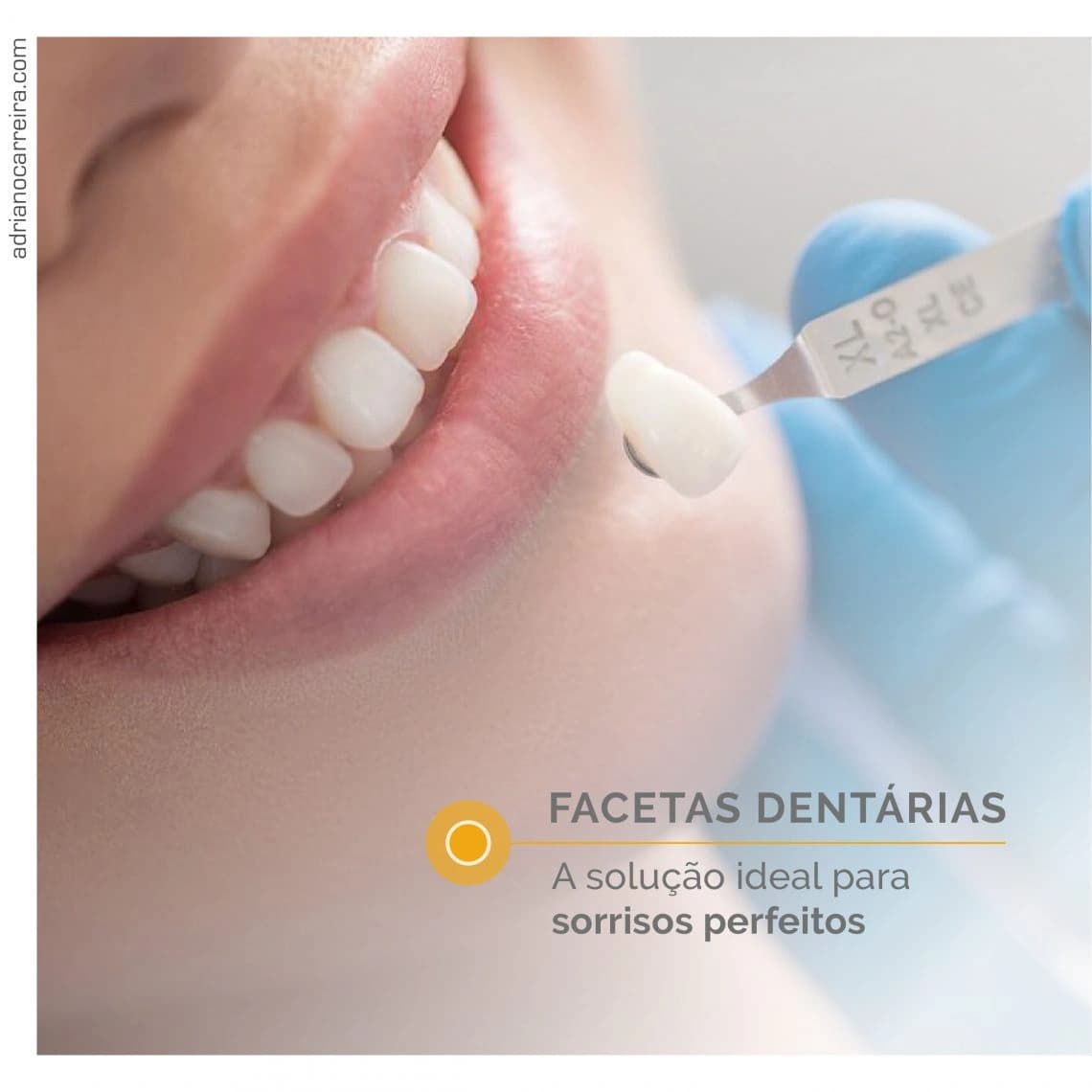 Facetas Dentárias: O Sorriso que sempre sonhou. Saiba como Facetas Dentárias: O Sorriso que sempre sonhou. Saiba como