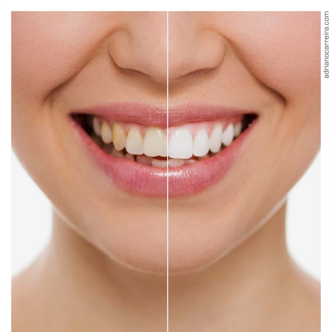 Verdades e Mitos Sobre Branqueamento Dentário Verdades e Mitos Sobre Branqueamento Dentário