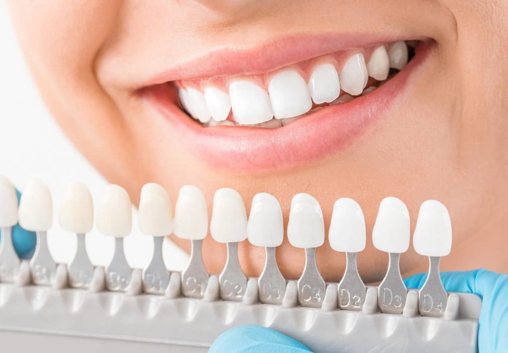 Branqueamento dentário: tudo o que precisa de saber! Branqueamento dentário: tudo o que precisa de saber!
