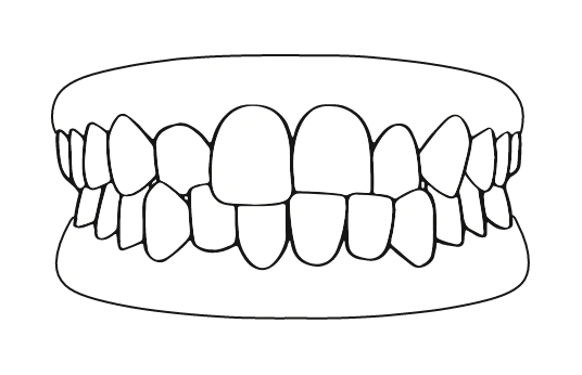 Mordida cruzada | Carreira Dental Clinic Mordida cruzada