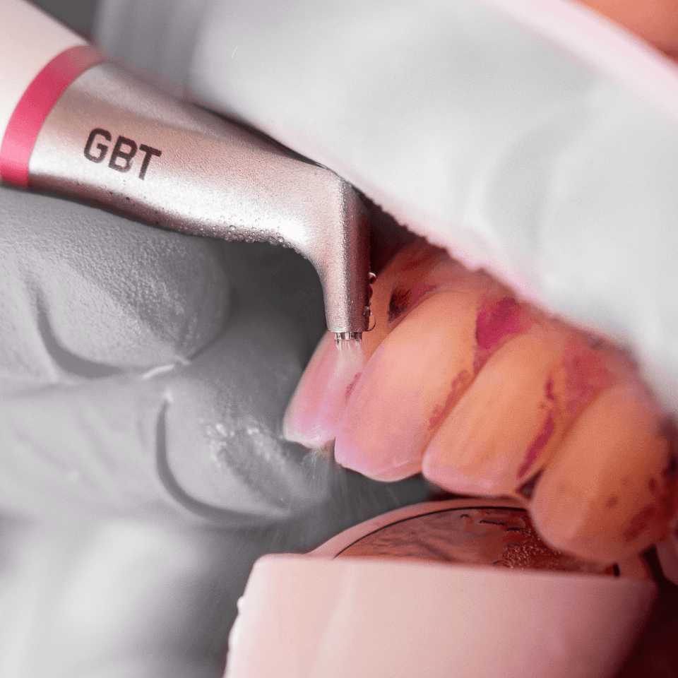 Higiene oral com GBT | Carreira Dental Clinic Higiene oral com GBT