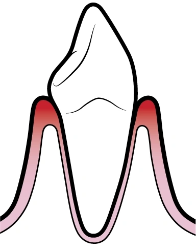 Gengivite | Carreira Dental Clinic Gengivite