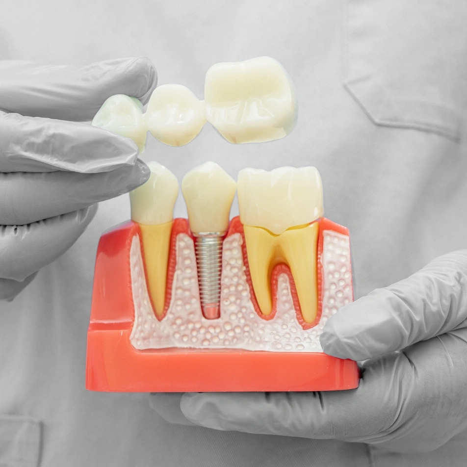 Colocação de coroas dentárias | Carreira Dental Clinic Colocação de coroas dentárias