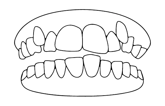 Dentes apinhados